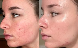 acné: tratamientos efectivos para adolescentes y adultos según la ciencia