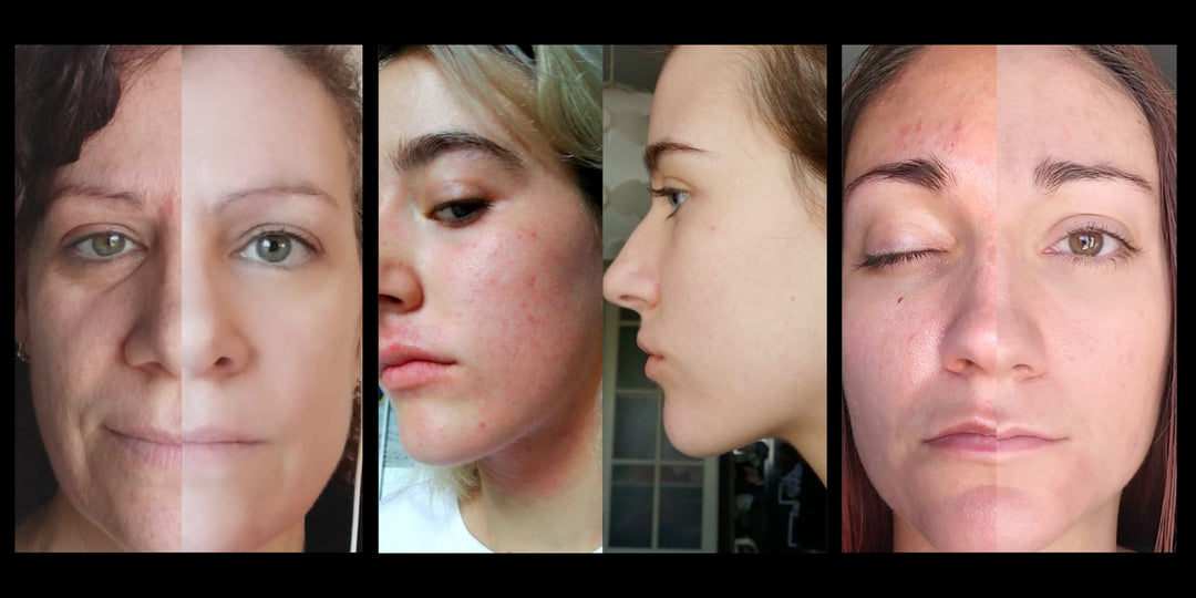 las cápsulas revolucionarias para olvidarte de la rosácea.